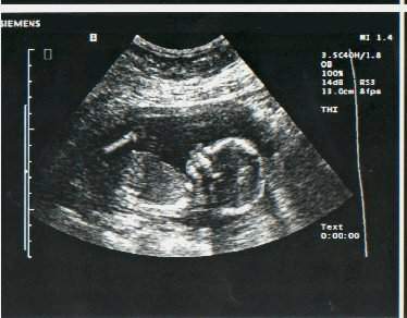 pregnancy-ultrasound-17-weeks