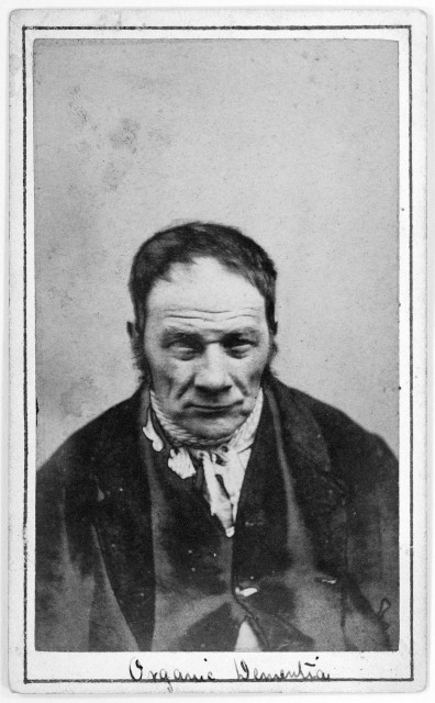 L0019067 Albumen prints: photographs of patients at Credit: Wellcome Library, London. Wellcome Images 