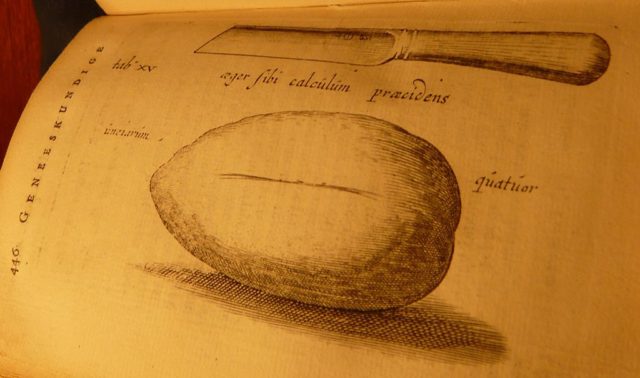 Illustration of the knife and bladder stone (publication 1740). Wikipedia/Public Domain
