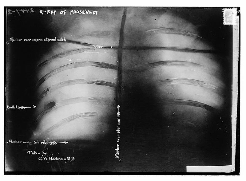 X-Ray of Schrank's bullet in Roosevelt's chest