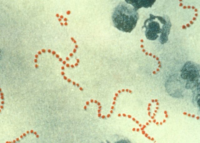 Streptococcus pyogenes (red-stained spheres) is responsible for most cases of severe puerperal fever. It is commonly found in the throat and nasopharynx of otherwise healthy carriers