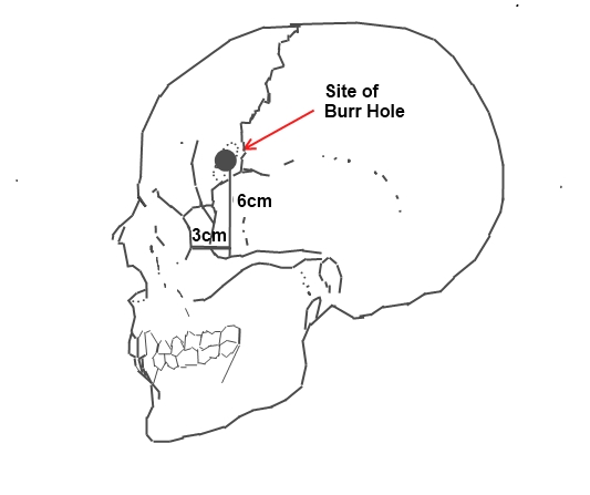 A site of the borehole for the standard pre-frontal lobotomy/leucotomy operation as developed by Freeman and Watts  Photo Credit