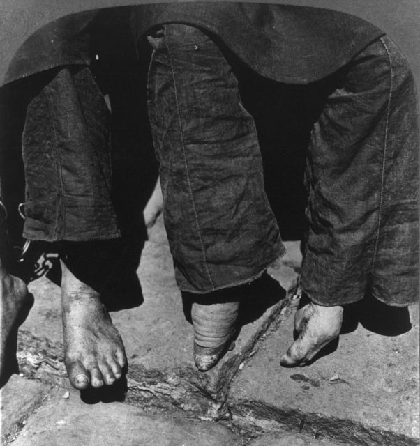 A comparison between a woman with normal feet (left) and a woman with bound feet in 1902