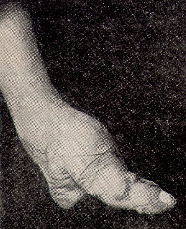 A bound foot