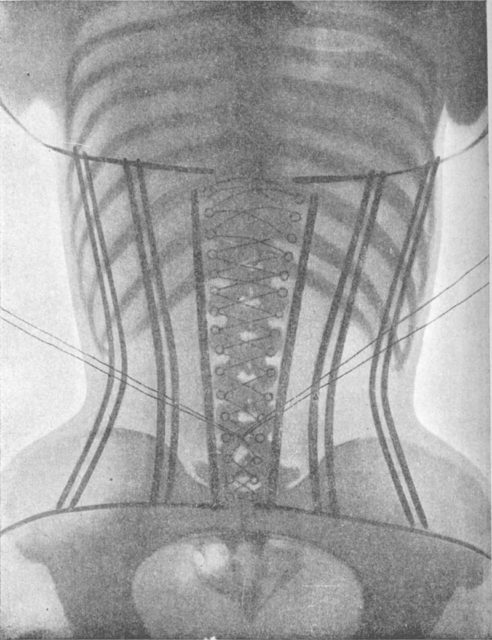 X-ray of a woman in a corset.