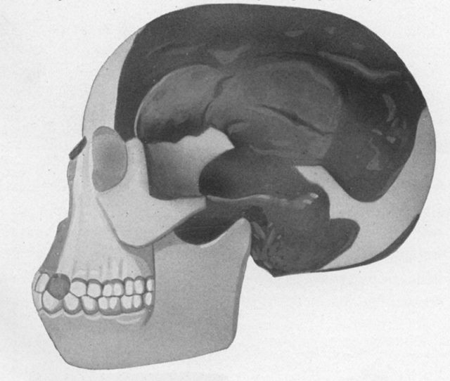 Piltdown Man skull reconstruction, 1922.
