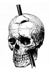 Phineas gage – 1868 skull diagram