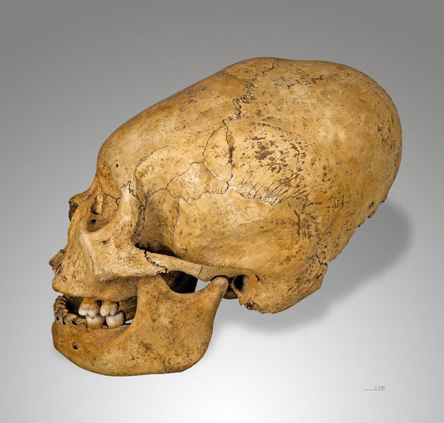 Skull with dolichocephaly induced Photo Credit