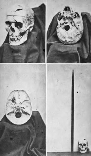 Gage's skull and tamping iron in the Warren Anatomical Museum, 1870 