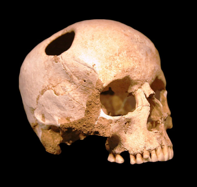 Trepanated skull, Neolithic Photo Credit