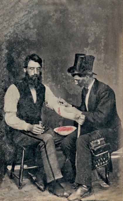 Bloodletting in 1860, one of only three known photographs of the procedure