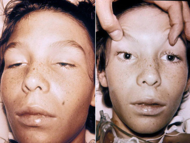 A 14-year-old with botulism. Note the weakness of the eye muscles and the drooping eyelids in the adjacent image and the large and non-moving pupils in the right image Photo Credit