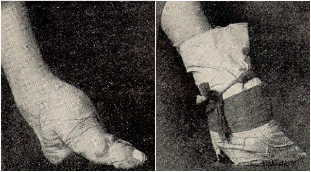 A bound foot and a bandaged bound foot