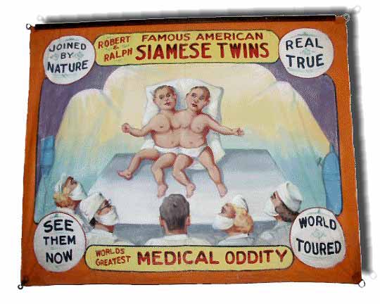 Robert And Ralph, Siamese Twins