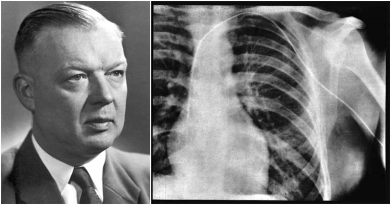 Werner Forssmann the Nobel winner who performed the first human