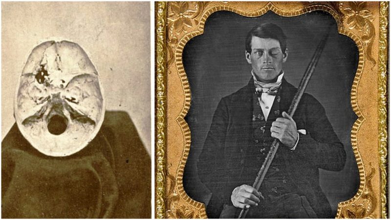 The bizarre story of how a railroad worker survived an iron rod which