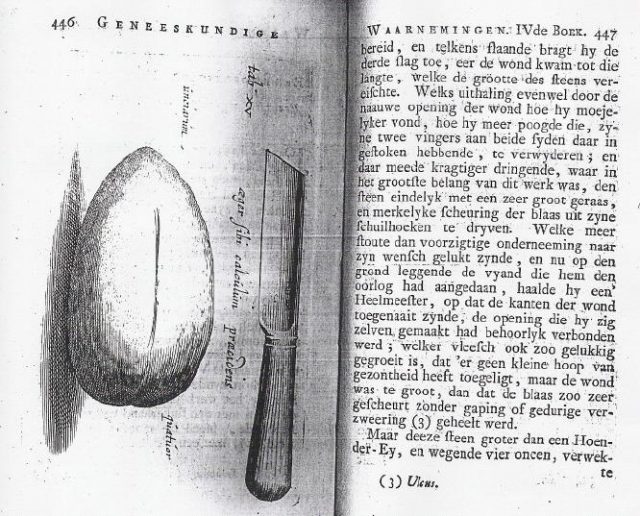 Scanned page showing the knife of Jan de Doot and the kidney stone he removed with said knife from his own kidney with the help of his brother in the 17th century. This story is described in the book Observationes Medicae by Nicolaes Tulp.
