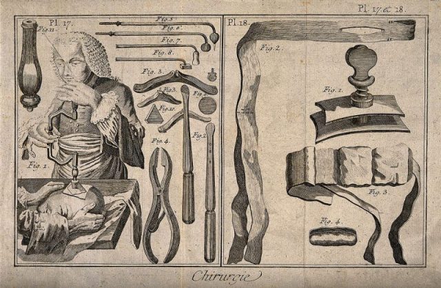Surgical instruments and patients undergoing treatment (trepanation). Engraving with etching. Photo by Wellcome Images CC BY SA 4.0