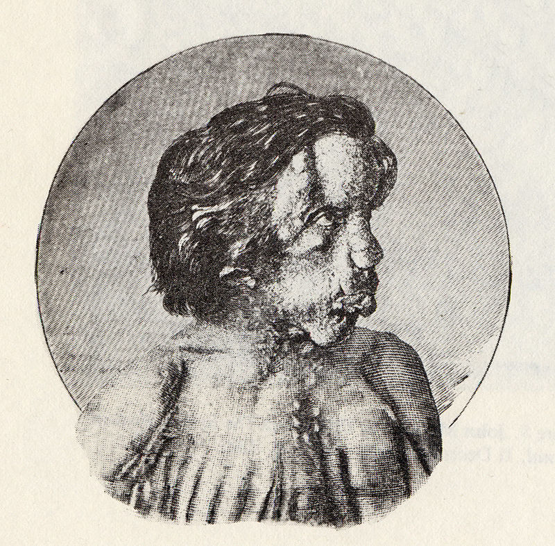 The Sad Life of the Real "Elephant Man" The Vintage News