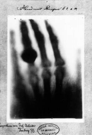 First medical X-ray by Wilhelm Röntgen of his wife Anna Bertha Ludwig’s hand