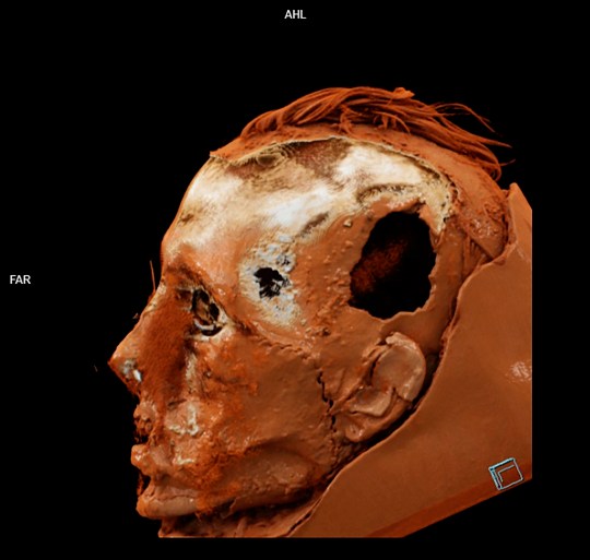 CT scan of the skin and skull with the scar and the trepanation hole visible (Credits: The State Hermitage Museum)