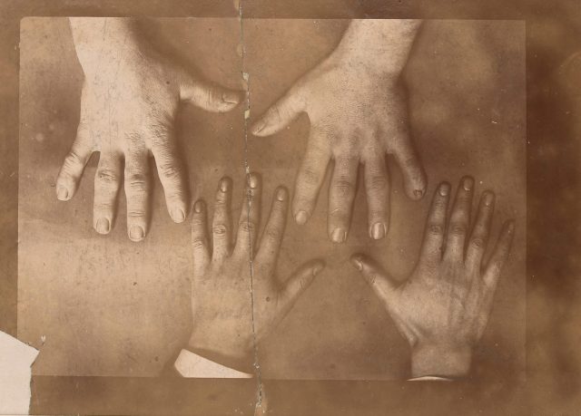hands of a man with acromegaly 