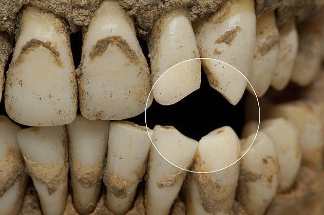 Distinctive markings on skeletons have given away secrets about the soldiers' lifestyles. Here the uniform teeth marking (ringed) suggests this man was avid pipe smoker. source

