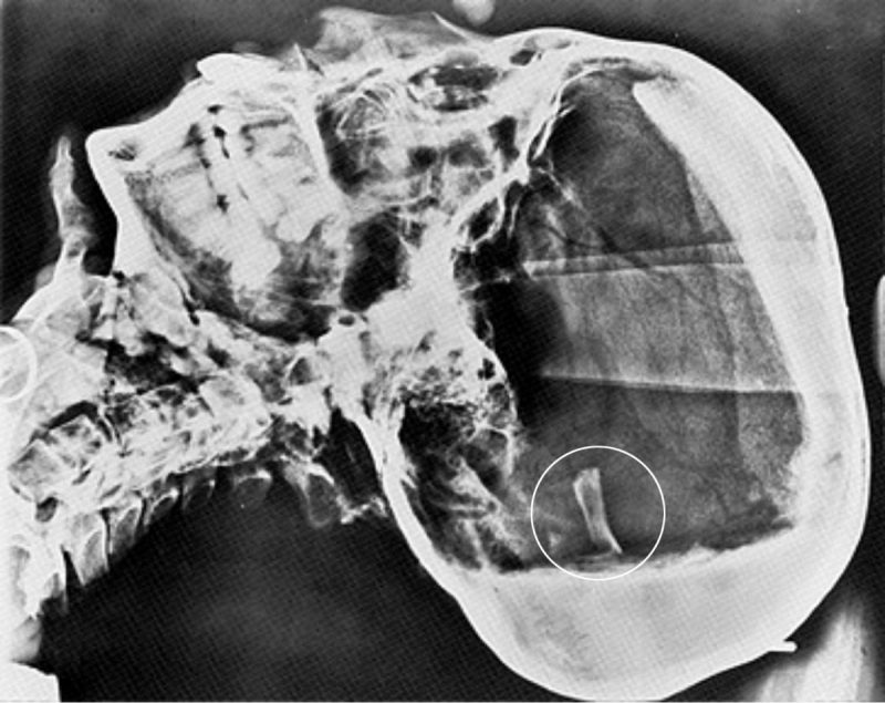 The first x-ray of Tut – showing a piece of bone (circled) detached from the skull – sparked speculation that his death was the result of foul play. © University of Liverpool