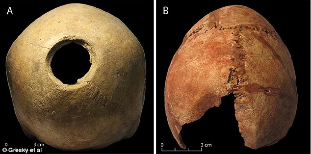 Of seven skulls unearthed at one site, five bear the marks of trepanation .Source:Gresky Et Al