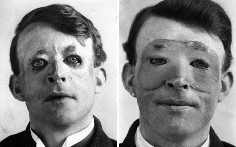 A photograph of Walter Yeo, showing his face before (left) and after the tube pedicle flap reconstruction of his face (right).