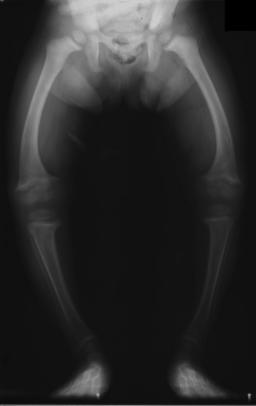 Radiograph of a two-year-old rickets sufferer, with a marked genu varum (bowing of the femurs) and decreased bone opacity, suggesting poor bone mineralization. Photo credit