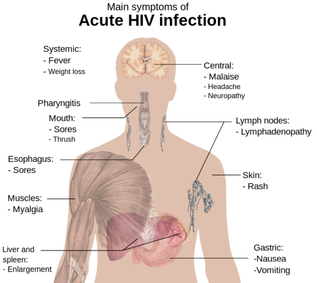 Main symptoms of acute HIV infection. Wikipedia/Public Domain