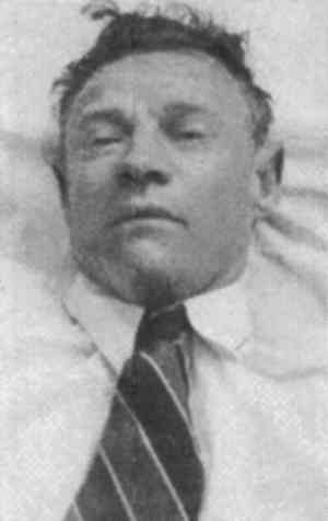 Image of the unknown dead man found on Somerton Beach, Adelaide, on the morning of 1 December 1948.