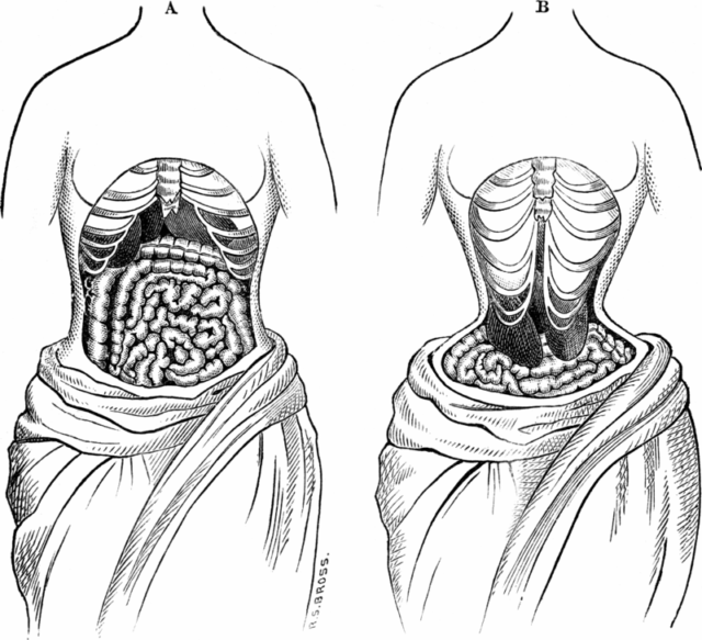 Two sketches from 1884 depicting what, at the time, was believed the way the inside of the body looked when wearing a corset