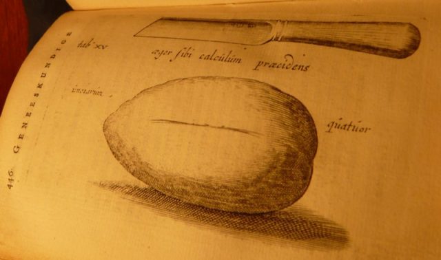 Illustration of the knife and bladder stone