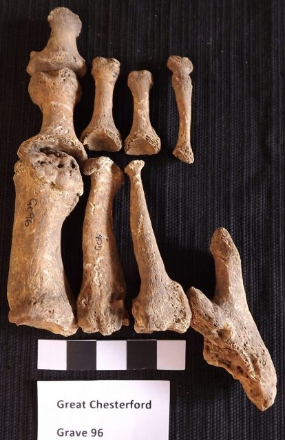 Skeletal remains from Great Chesterford showing evidence ofleprosy. This is the oldest known case of leprosy in the United Kingdom./Photo credit:/Sarah Inskip