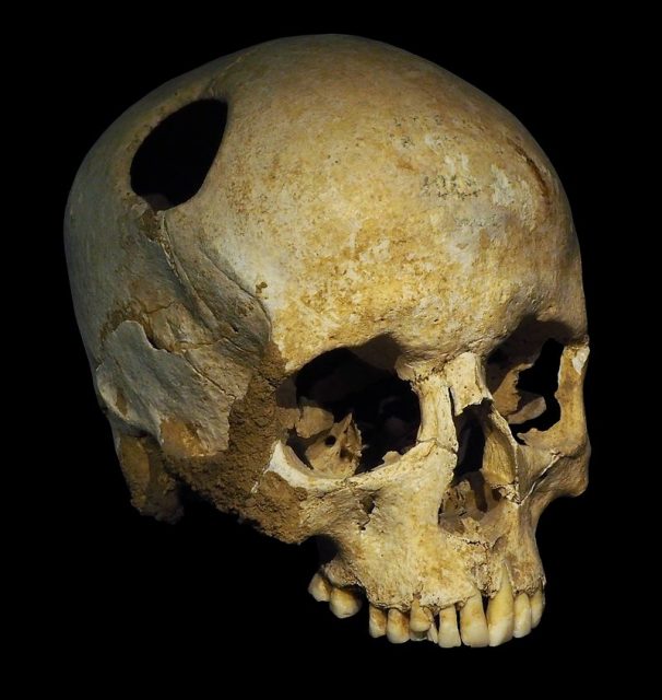 The perimeter of the hole in this trepanated Neolithic skull is rounded off by ingrowth of new bony tissue, indicating that the patient survived the operation. Photo by: Rama CC BY-SA 3.0 fr