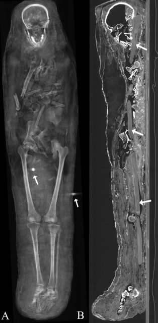 (A) thick-slab mean intensity coronal multi-planar reconstruction illustrates one metal object close to the right femur, suggested to be a translocated metal seal, and another metal seal on the outer textile layer (arrows); (B) sagittal multi-planar reconstruction visualizes parts of a broken wooden board placed beneath the body (arrows). Zesch S, et al. PLOS One / CC BY 4.0