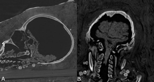 Fig 15. Young female mummy (CG 33281) with shrunken brain and brainstem preserved.(A) sagittal multi-planar reconstruction; (B) coronal multi-planar reconstruction.. Zesch S, et al. PLOS One / CC BY 4.0