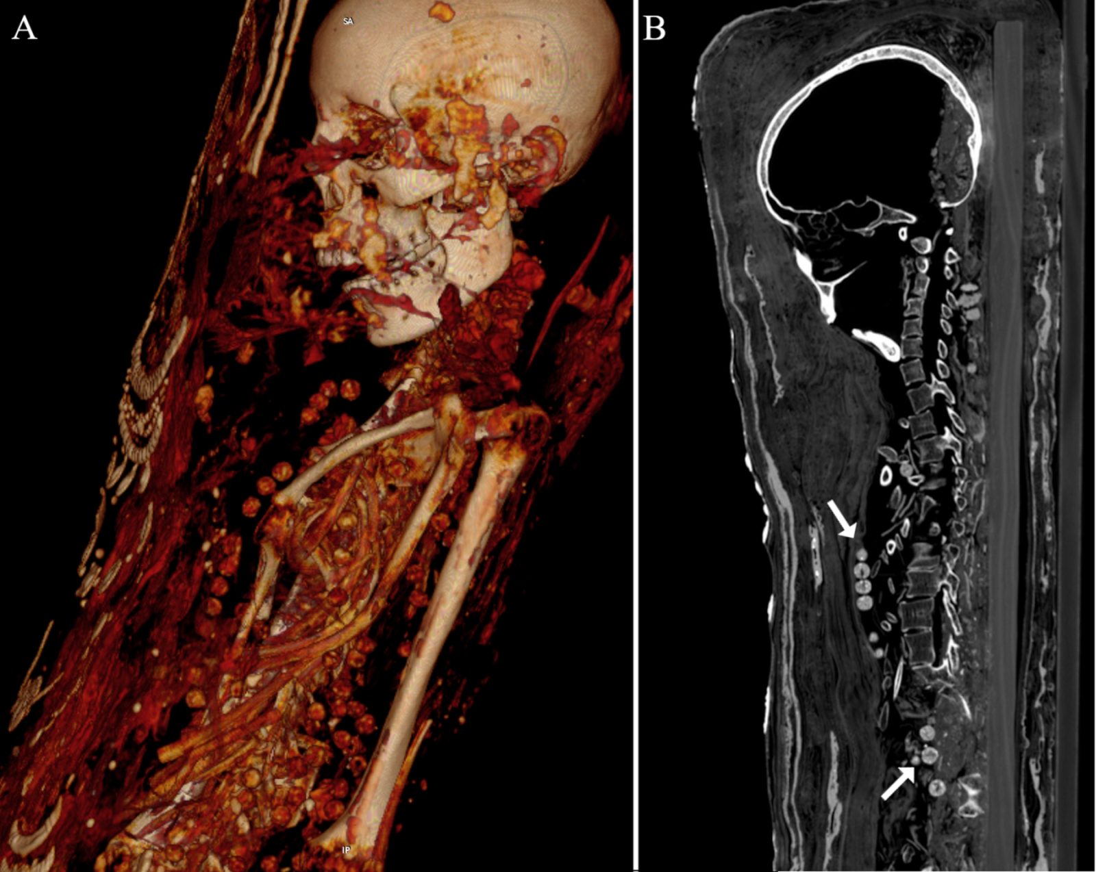 Fig 17. Female mummy (Aeg 778).

(A) volume rendered reconstruction illustrates numerous scattered beads in the thoracic region; (B) sagittal maximum intensity reconstruction shows a few of the perforated beads in detail (arrows).. Zesch S, et al. PLOS One / CC BY 4.0
