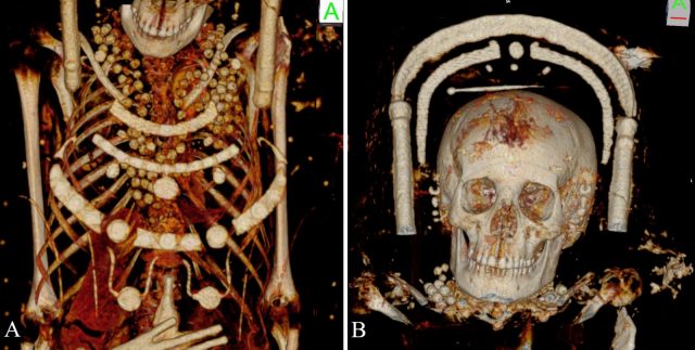 (A) numerous beads around the neck and on the thoracic region, suggesting an intact necklace/or several necklaces; (B) a hairpin on top of the head indicating an upswept hairstyle.. Zesch S, et al. PLOS One / CC BY 4.0