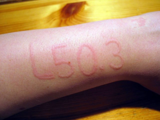Dermatographic urticaria, raised letters shown on skin