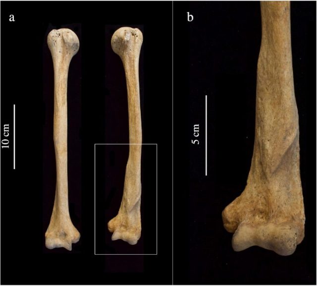 close-up of antemortem fracture of distal left humerus