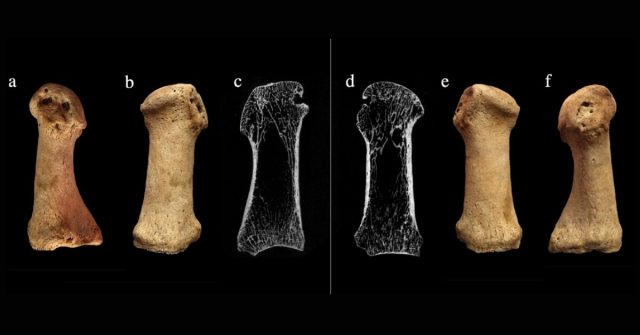 Lesions associated with hallux valgus (PSN 525) in an adult female individual from the Augustinian friary.