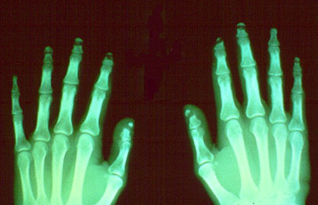 X-ray of two hands