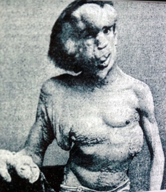 Photograph of Joseph Merrick