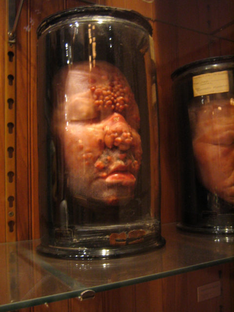 A head preserved in a jar