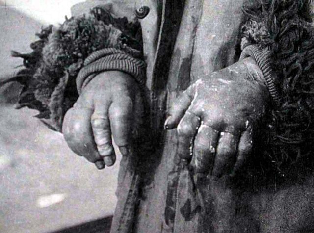 A photo of the frostbitten hands of a Chinese experiment victim