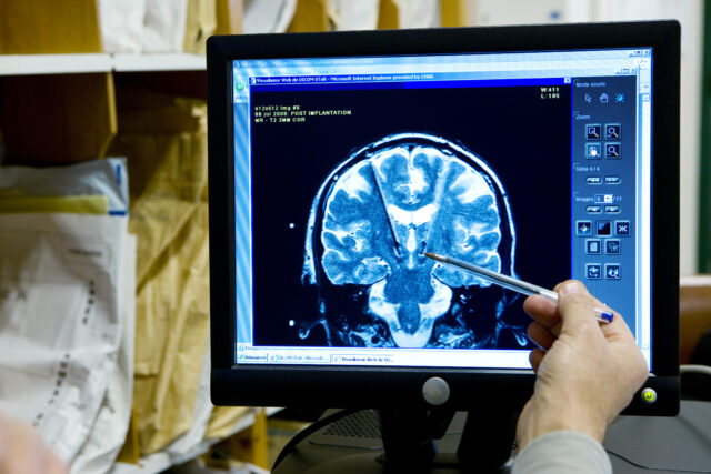 Someone holding a pen to a brain scan on a screen.