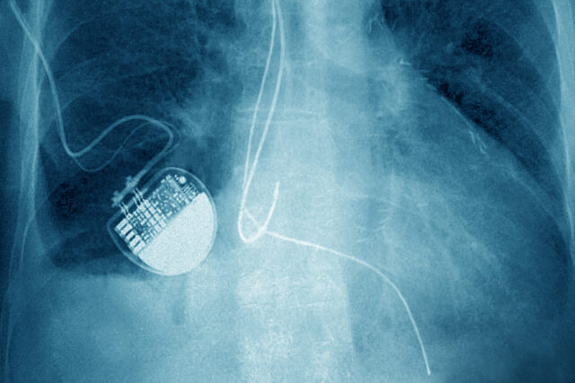 X-ray of a pacemaker in someone's chest